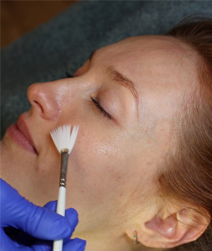 BioRivitalizzazione, segni del tempo, texture irregolare, pori dilatati, cicatrici acne