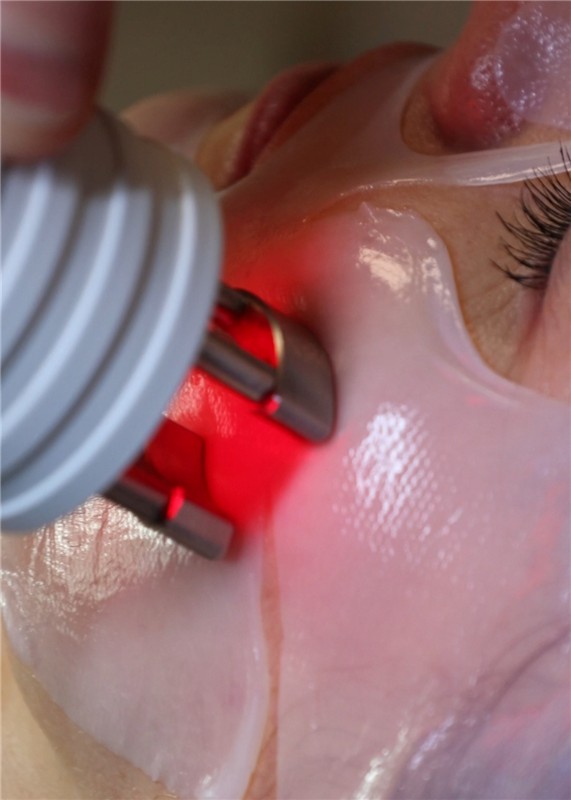 Filler del viso, del Collo e Décolleté Senza Aghi